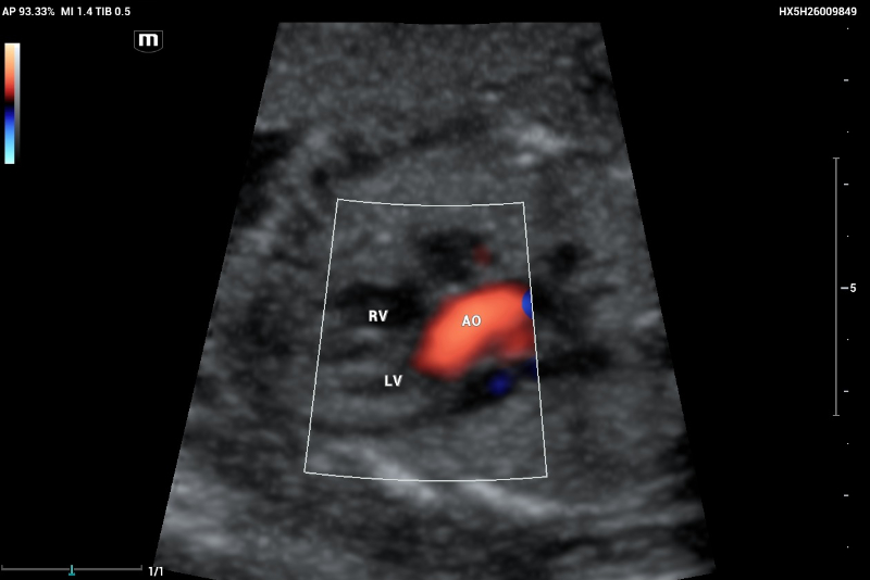 An example of normal echocardiography performed on Mindray Resona I9 system.  Artery–ventricle concordance showing the aortic outflow tract (AO) emerging of the left ventricle (LV)