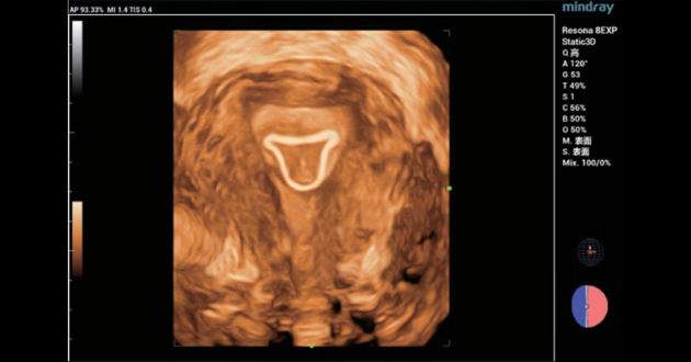 intrauterine-device-fig4-pc