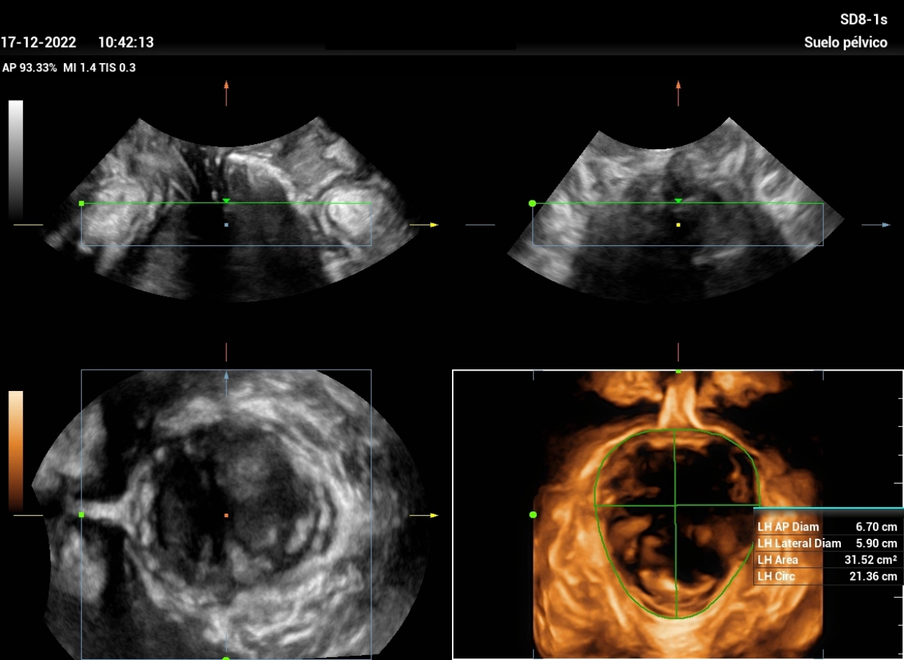Ultrasound Journal 21 Ultrasound Evaluation of Stress Urine
