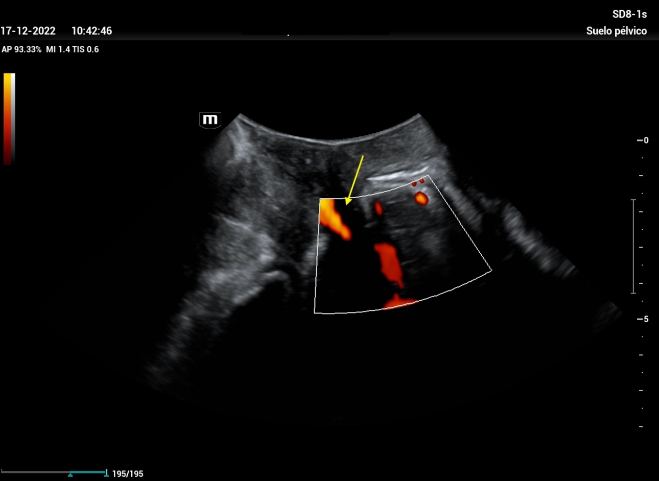 Ultrasound Journal 21 Ultrasound Evaluation of Stress Urine