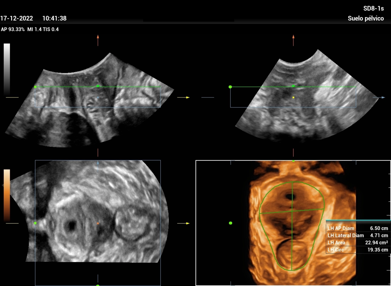 Ultrasound Journal 21 Ultrasound Evaluation of Stress Urine