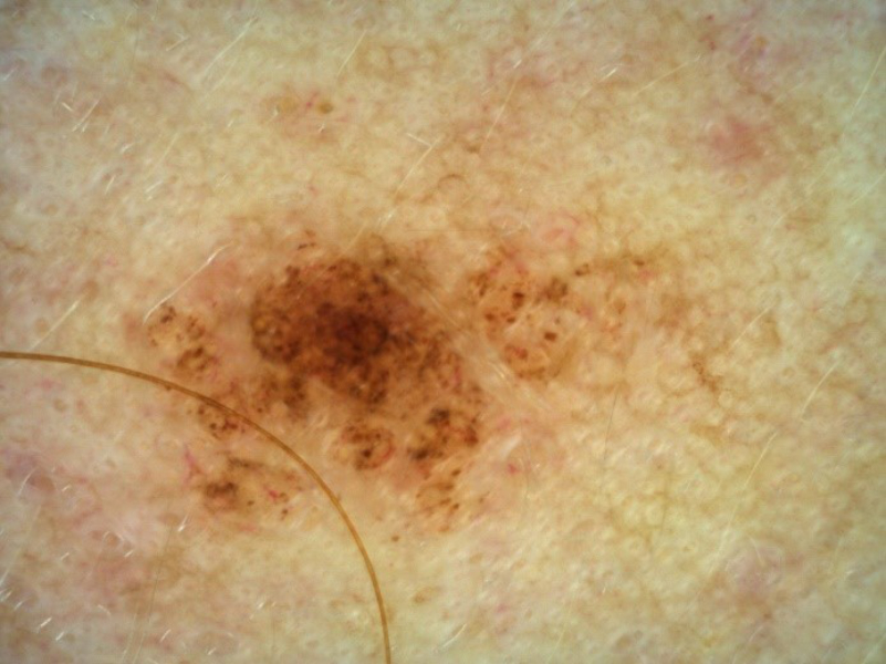 Dermatoscopic examination of the nevus