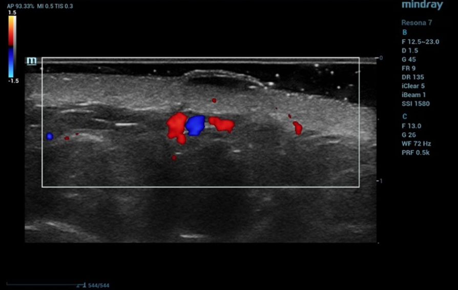 Ultrasound diagnostics of the nevus using the high-frequency transducer