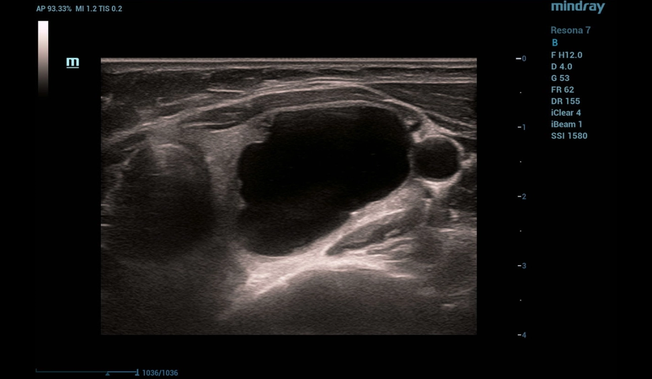 throid-sclerotherapy-fig1-pc