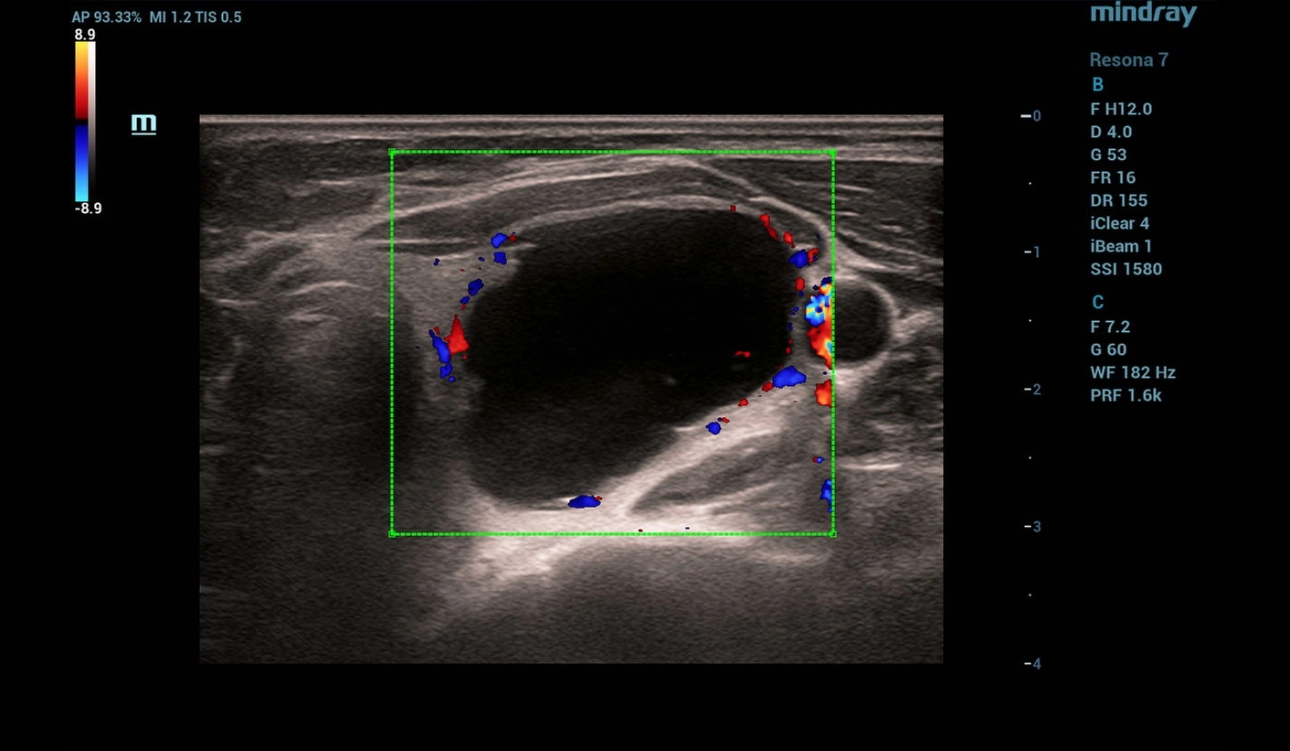 throid-sclerotherapy-fig2-pc