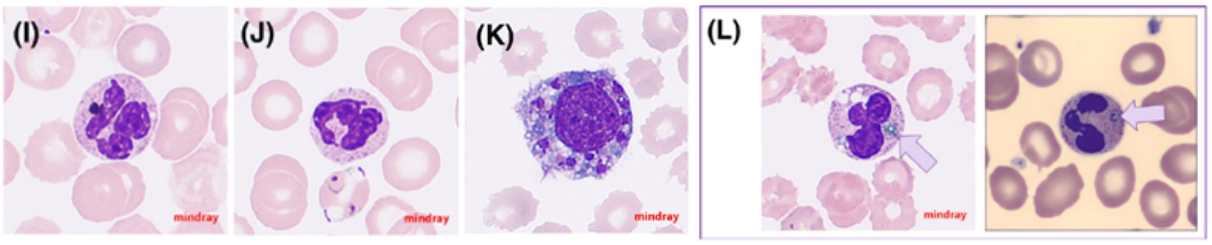 wbc-diff-digi-morphology-fig12-pc