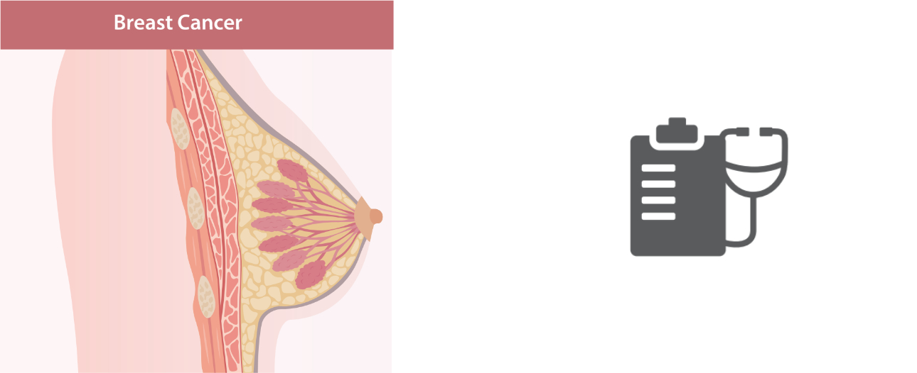 Breast cancer