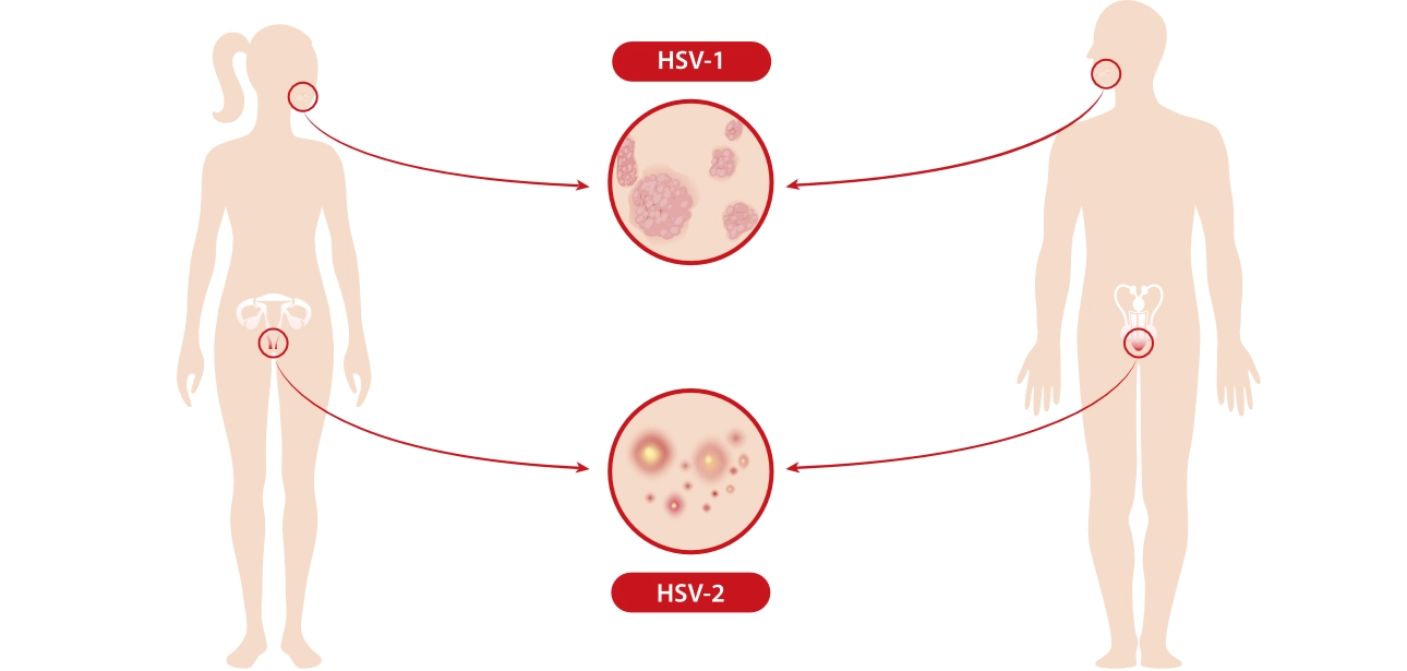 HPV Type 1 and 2 spreads through oral and sexual contact