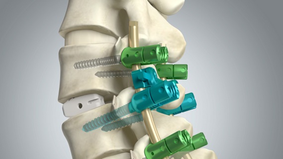 mindray-orthopaedics distributor-spine-pc