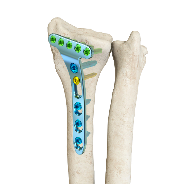 Trama Comprehensive Solution - Locking Plate - Mindray