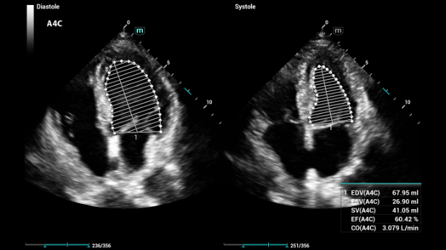 Solução Cardiovascular Série Consona - AutoEF apresenta imagem clínica