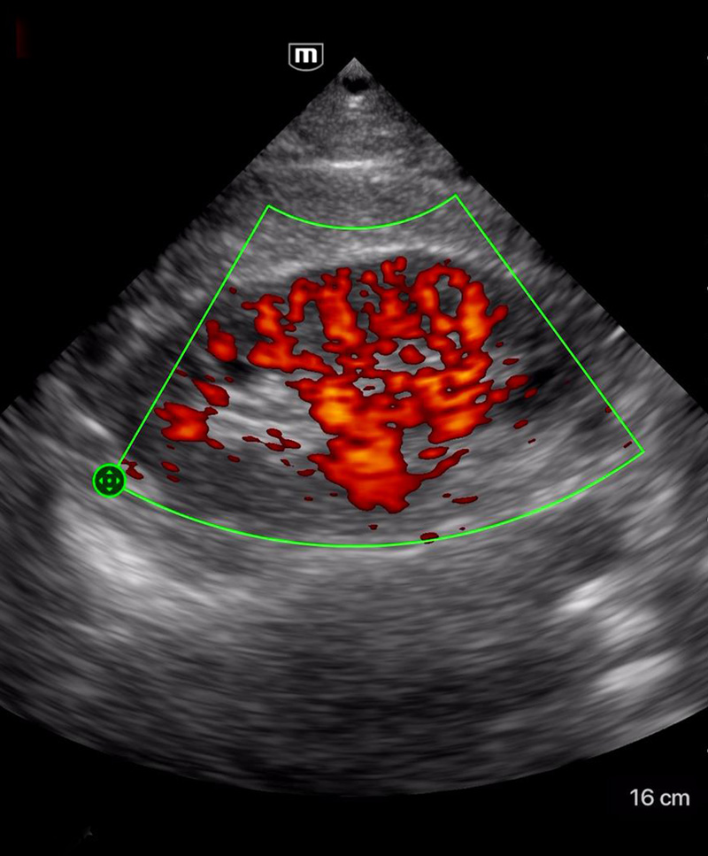 Ecógrafo Portátil Doppler Color Mindray - ALLMEDICA Equipos Médicos