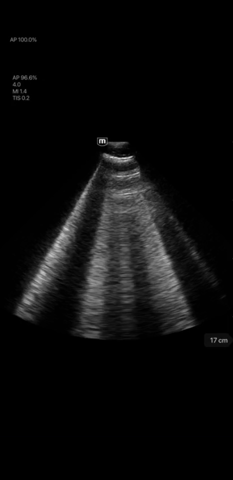 Ligne B pulmonaire