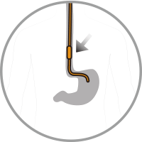 Auxiliary catheter placement icon