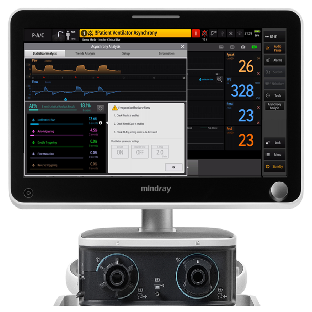 Patient-ventilator asynchrony analysis tool interface screenshot