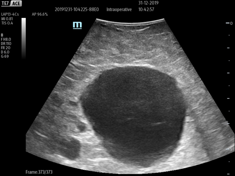 LAP13-4Cs_Liver_Tumor_4_800x600