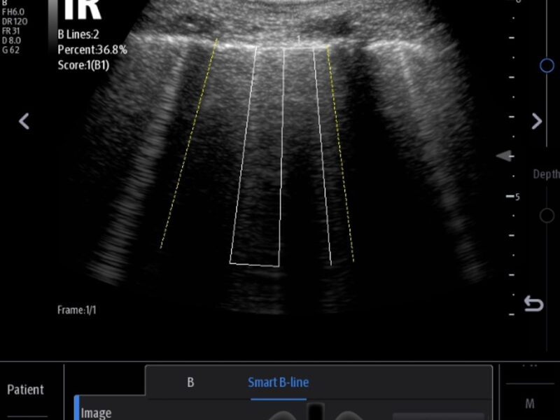 TE7ACE_Smart_B-line_Clinical