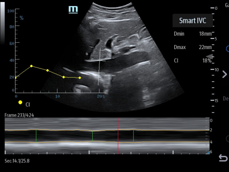 TE7ACE_Smart_IVC_Clinical