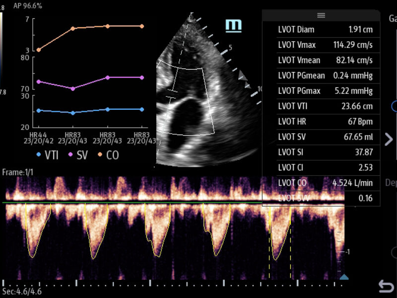 TE7ACE_Smart_VTI_Clinical