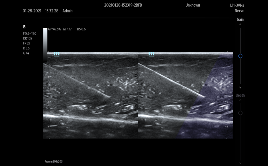 L12-3VNs_iNeedle-925x576