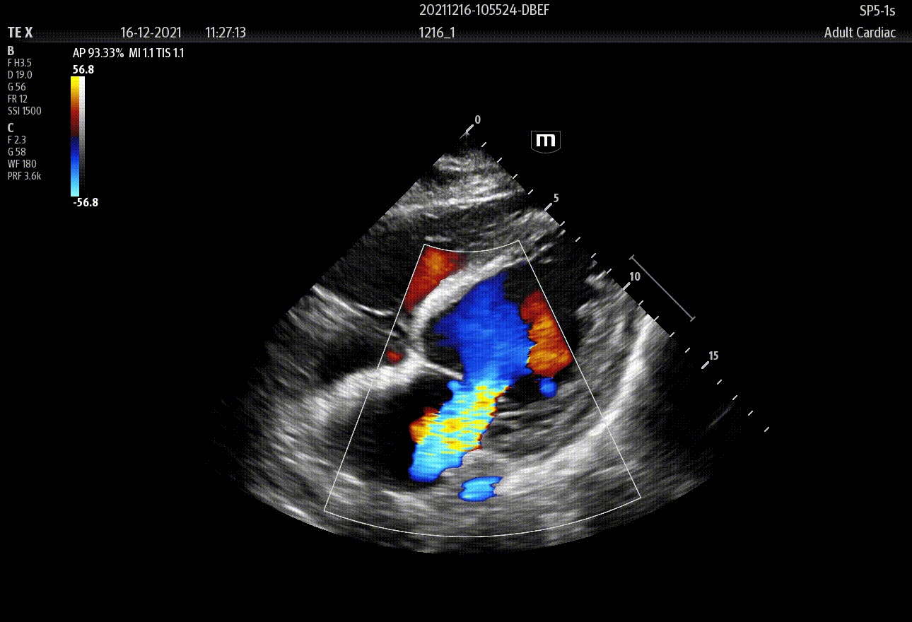 SP5-1s_S4C_Mitral stenosis_Color_2