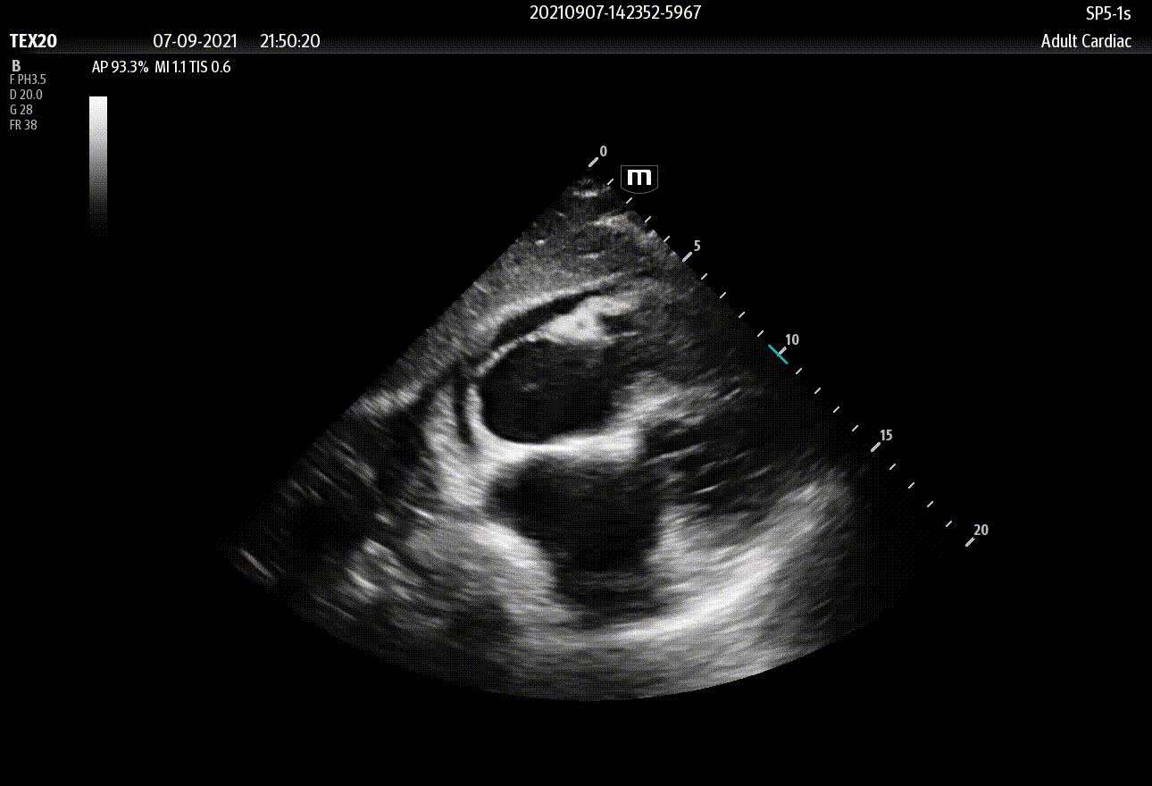 SP5-1s_S4C_Pericardial effusion_2D