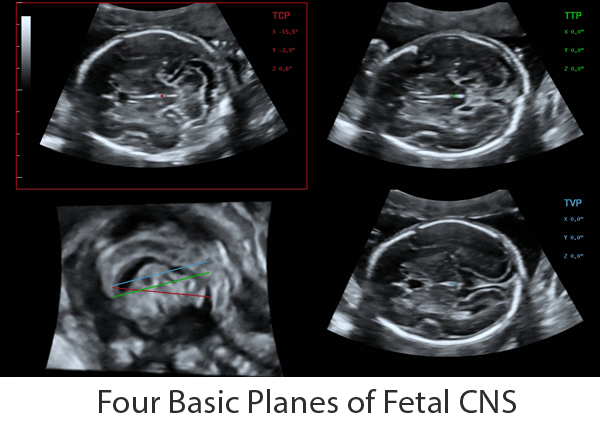 Consona_4-Fetal_Planes_PC_600x429