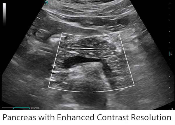 Consona_Pancreas-w-HD-Scope_PC_600x429NEW