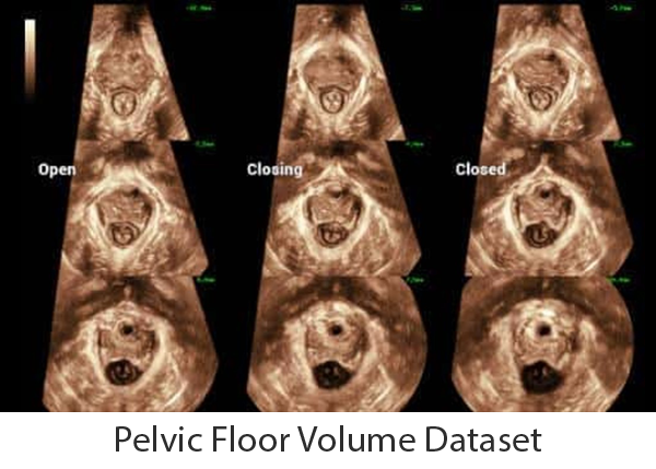 Consona_pelvic_floor_PC_600x429