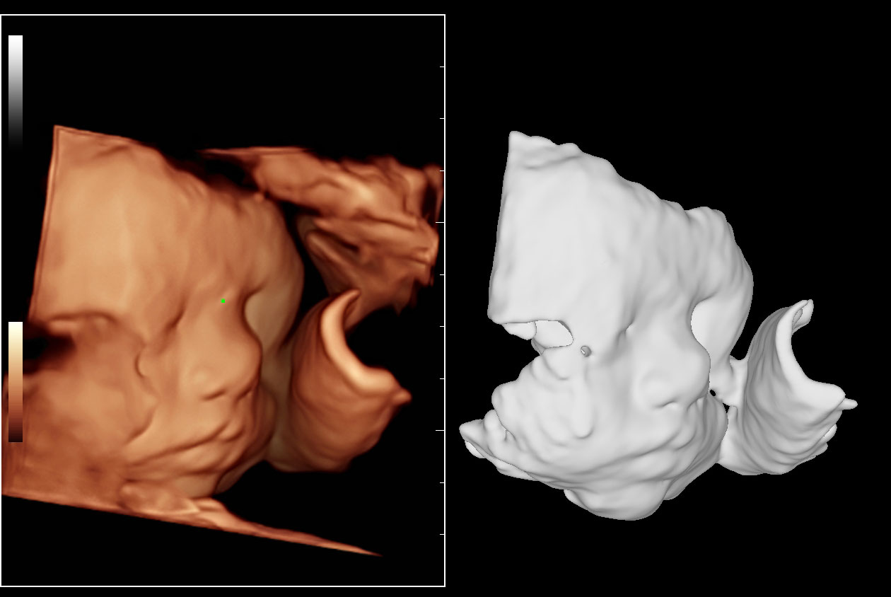 SD8-1_Fetal_Face_3D_N9_HD_Zoom_1260x844