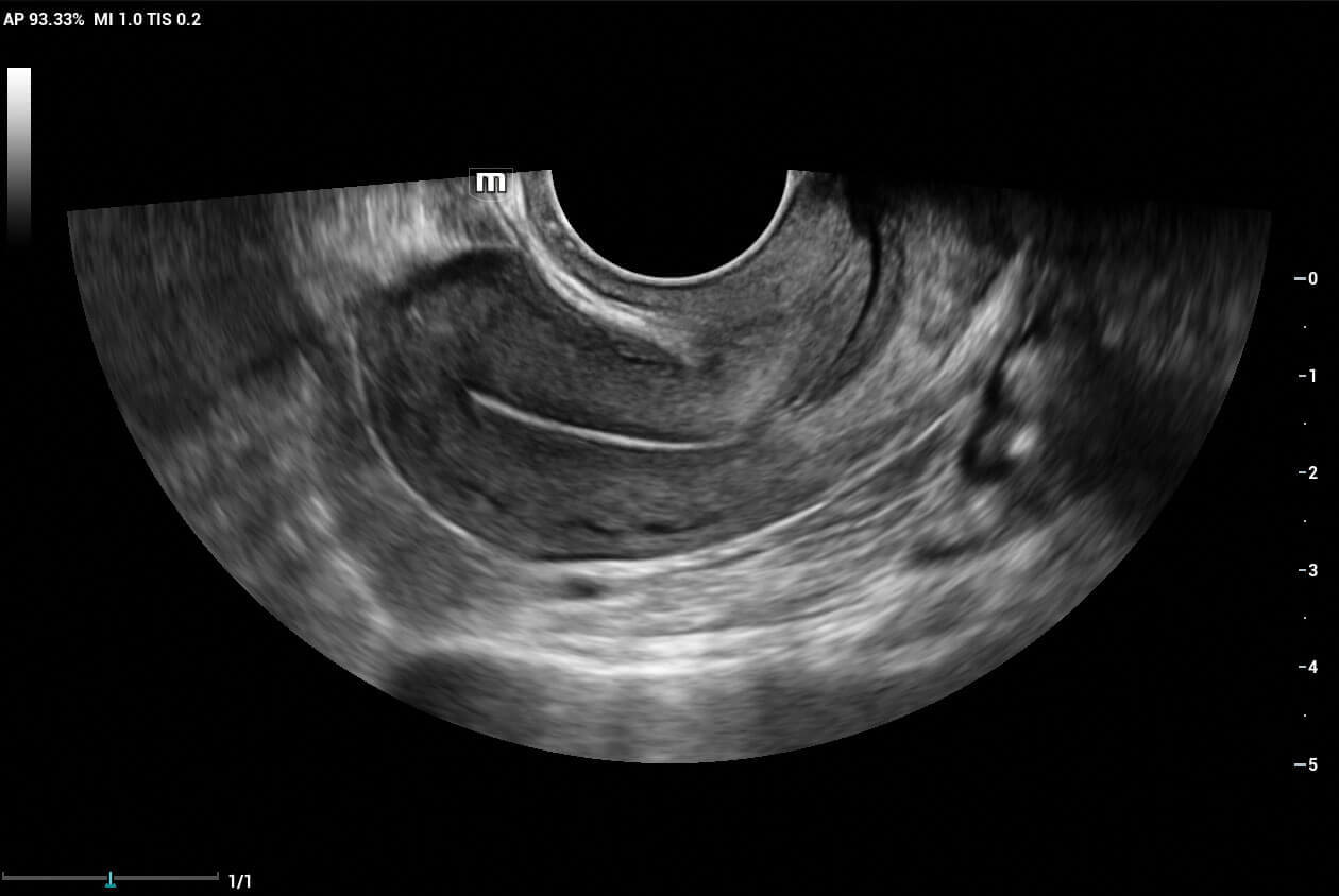2D-endocavity-image-of-Uterus