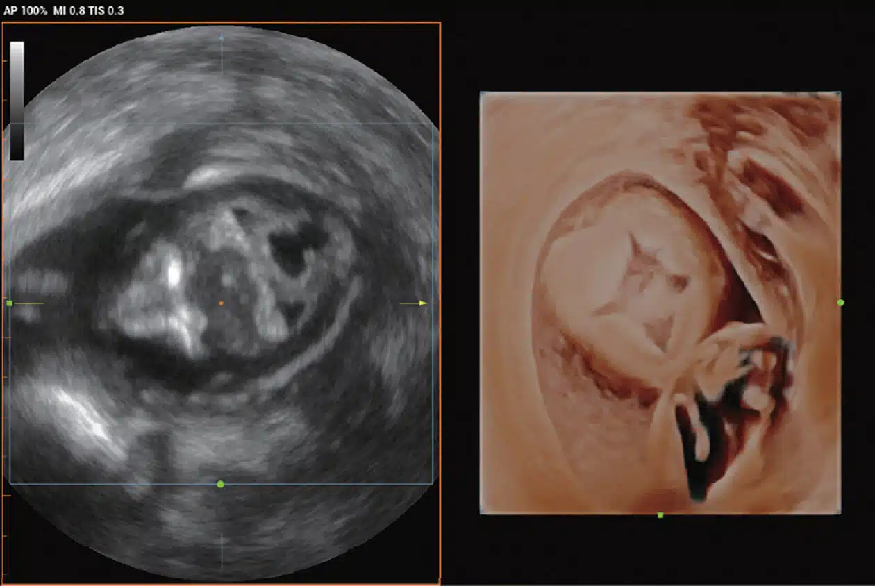 Fetal-brain-malformation_Imagyn-I9.jpg