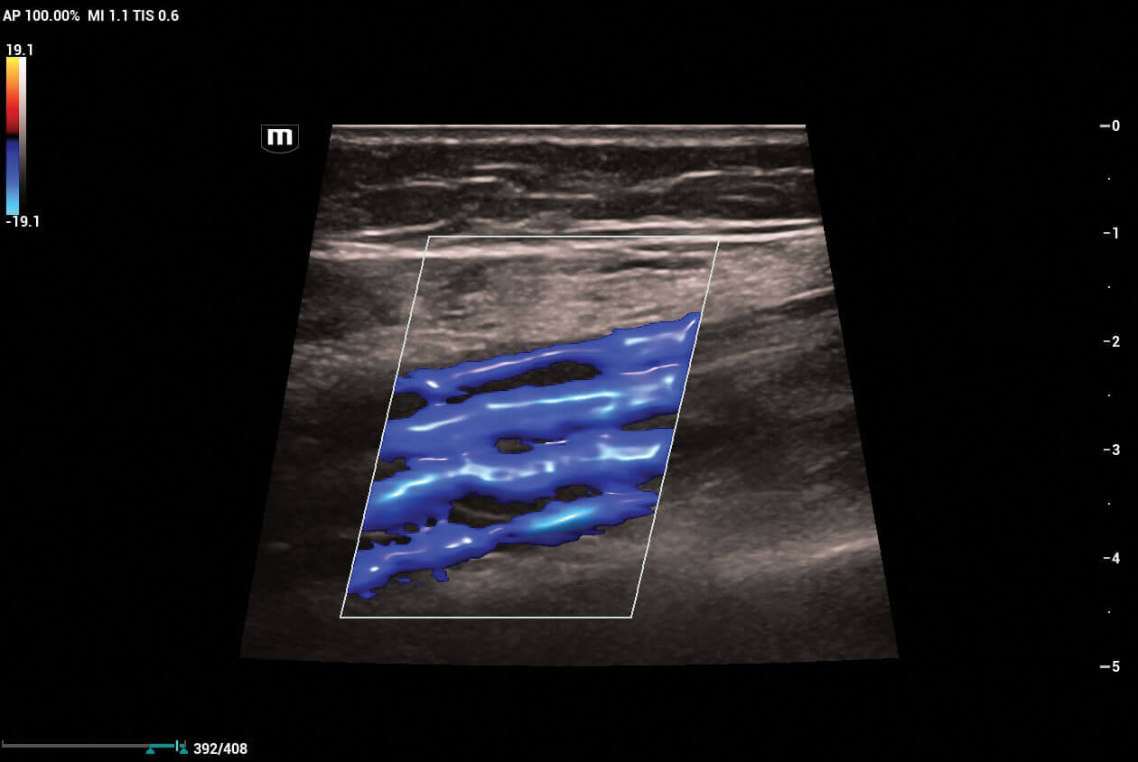 Glazing-Flow-or-Posterior-Tibial-and-Peroneal-Veins-1