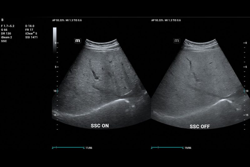 Liver-Tissue-enhanced-by-Sound-Speed-Compensation-2-800x534