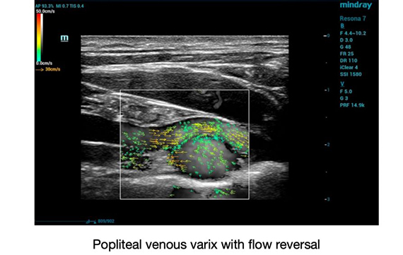 Popliteal-venous-varix-with-flow-reversal_570x361