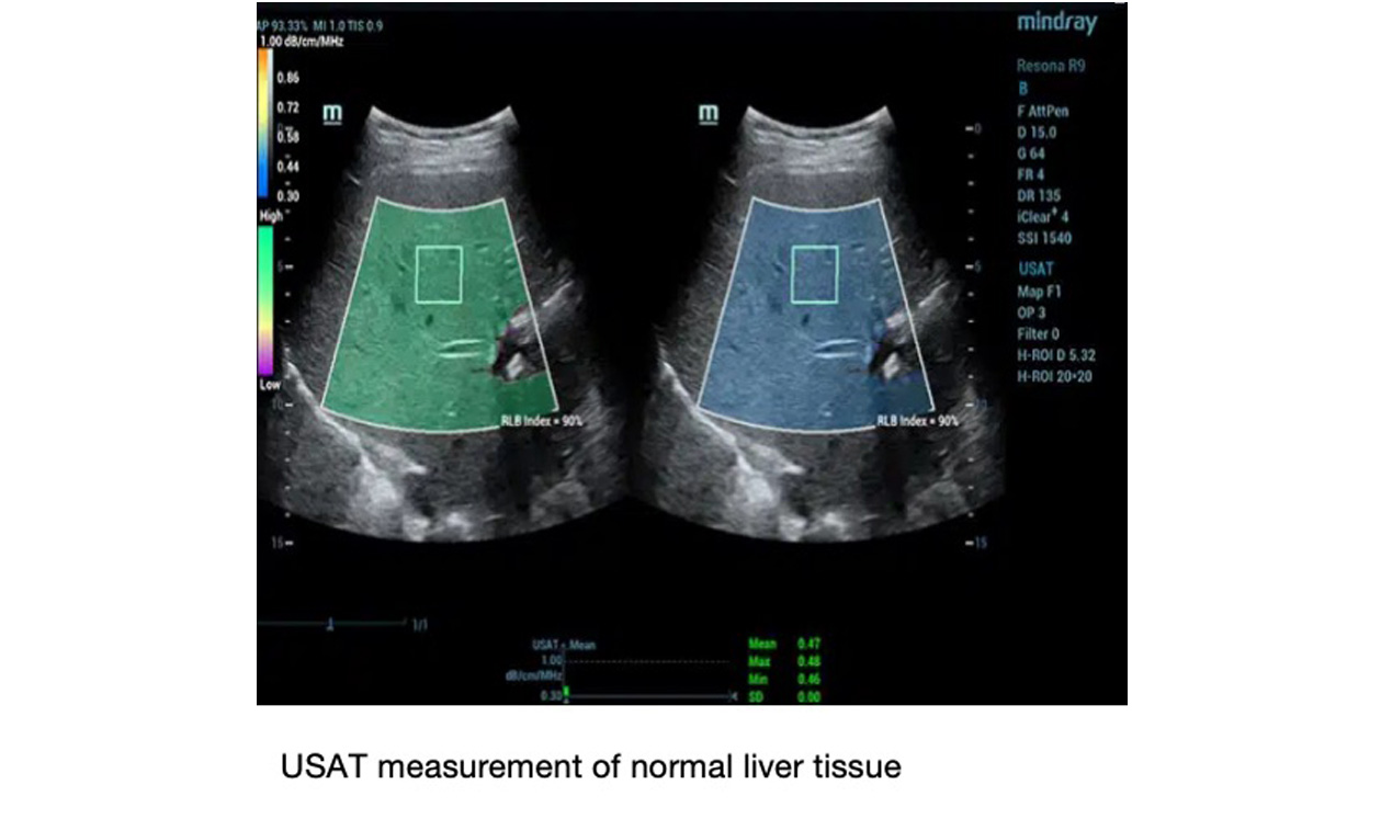 USAT_meaurementofnormallivertissue