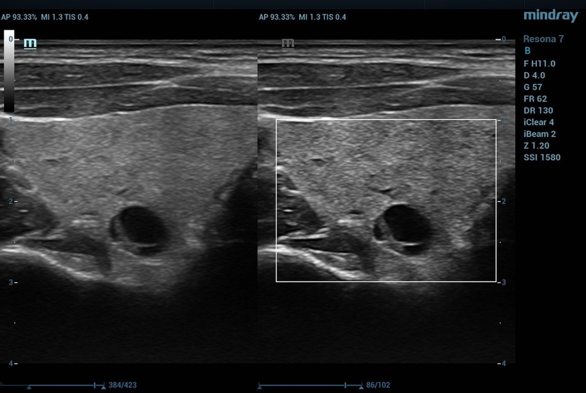 HDScopethyroidlesion