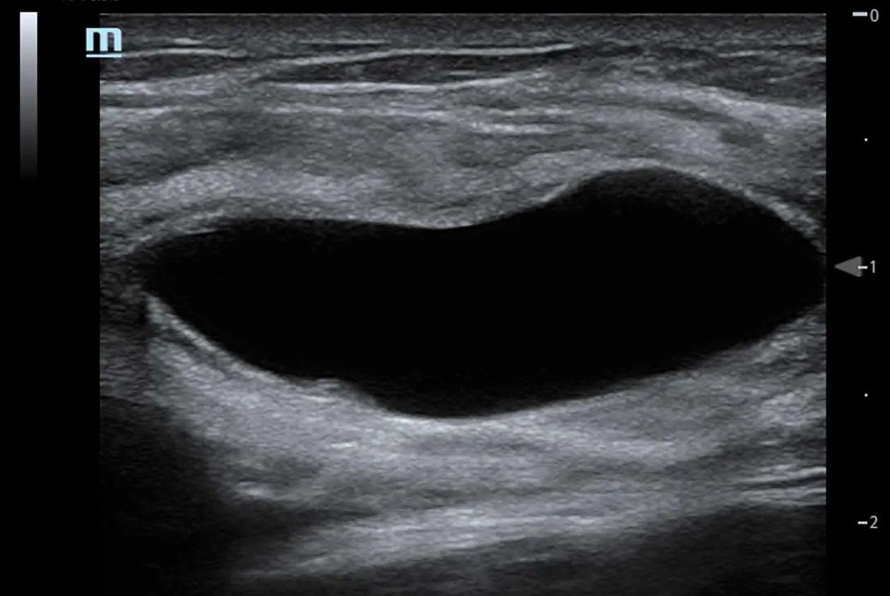 Breast Cyst Ultrasound
