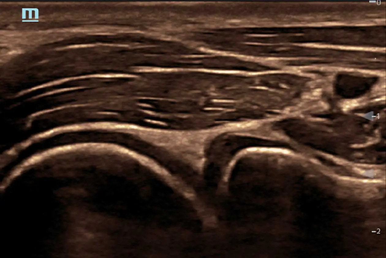 Humerus Ultrasound Image 