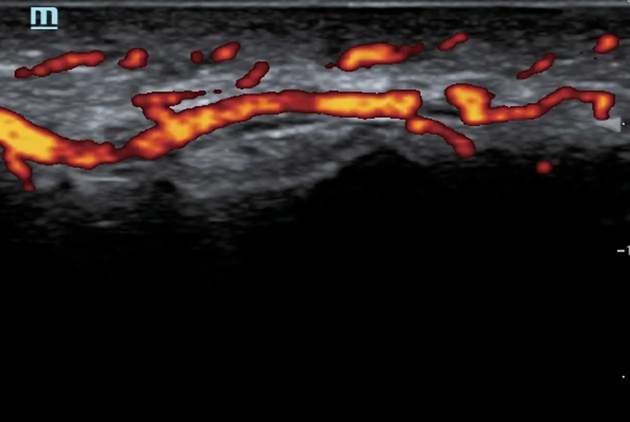 Vascular Flow Ultrasound Image 