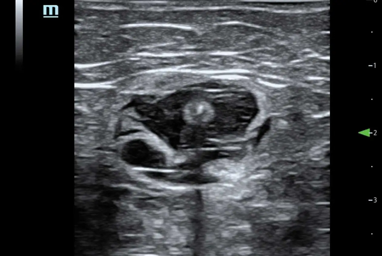 Vein Ablation Ultrasound Image 