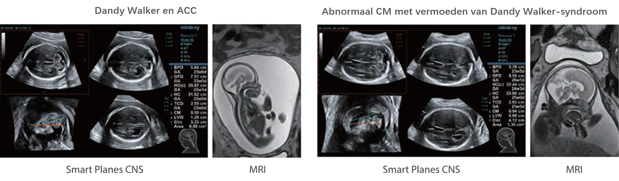 MRI