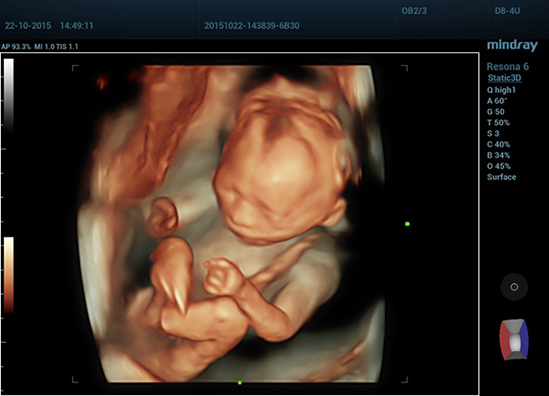 07 3D of Fetal Profile