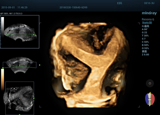 08 3D of Bicornuate uterine anomaly