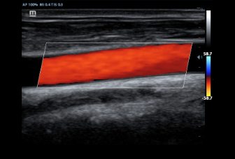 07-7l4p-carotid-cfm