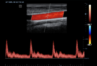 08-7l4p-carotid-pw