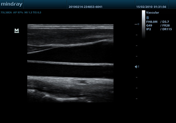 Carotid Artery