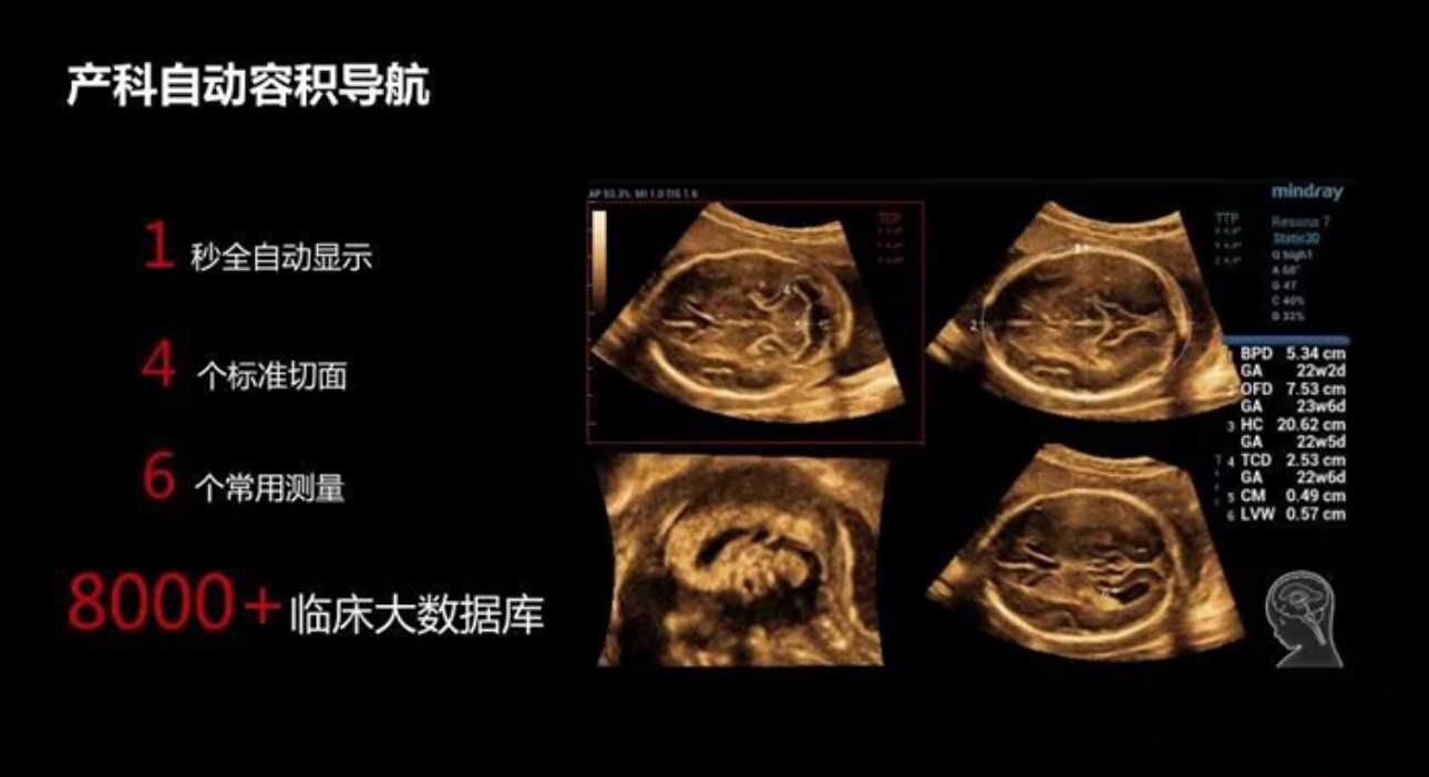 产科自动容积导航