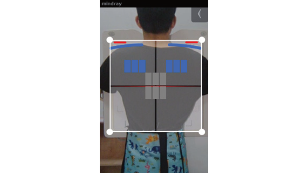 凌云 DigiEye U 系列数字化摄影X射线系统 - 规范化AI摆位助手