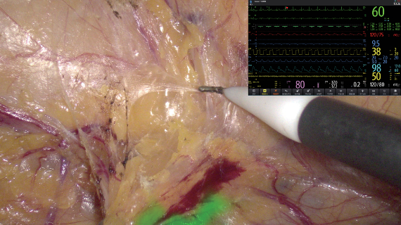 surgi-core-fig3-4-pc